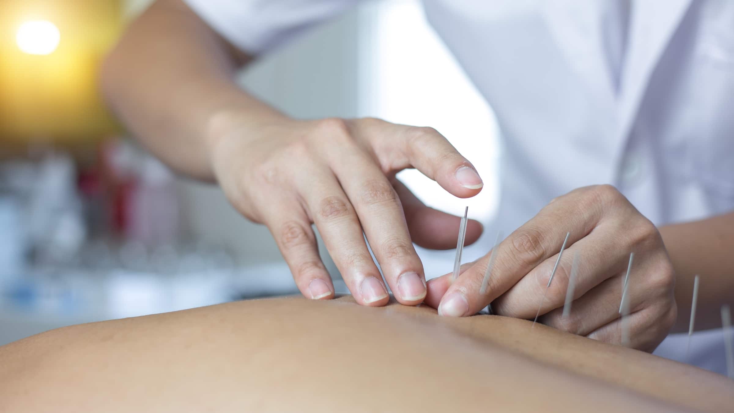 Acupuncture in Vancouver