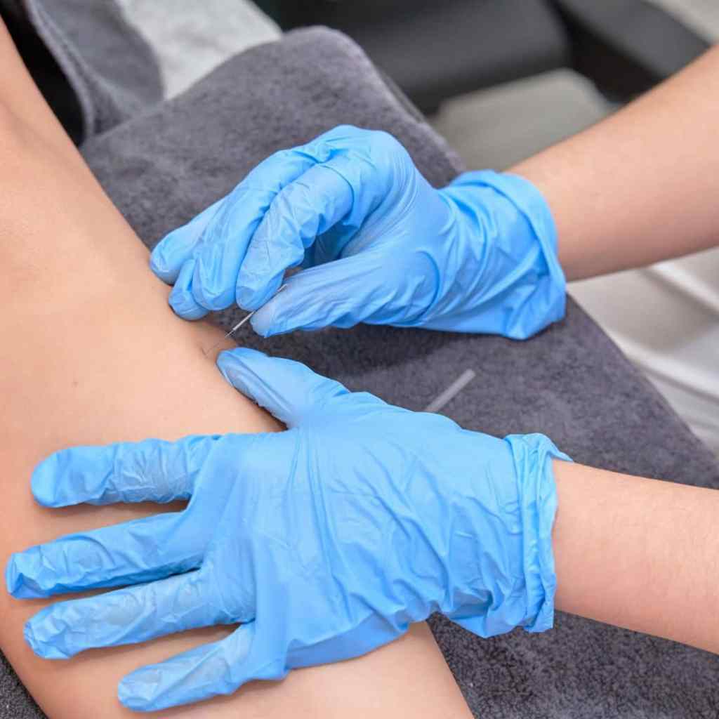 dry needling in Vancouver